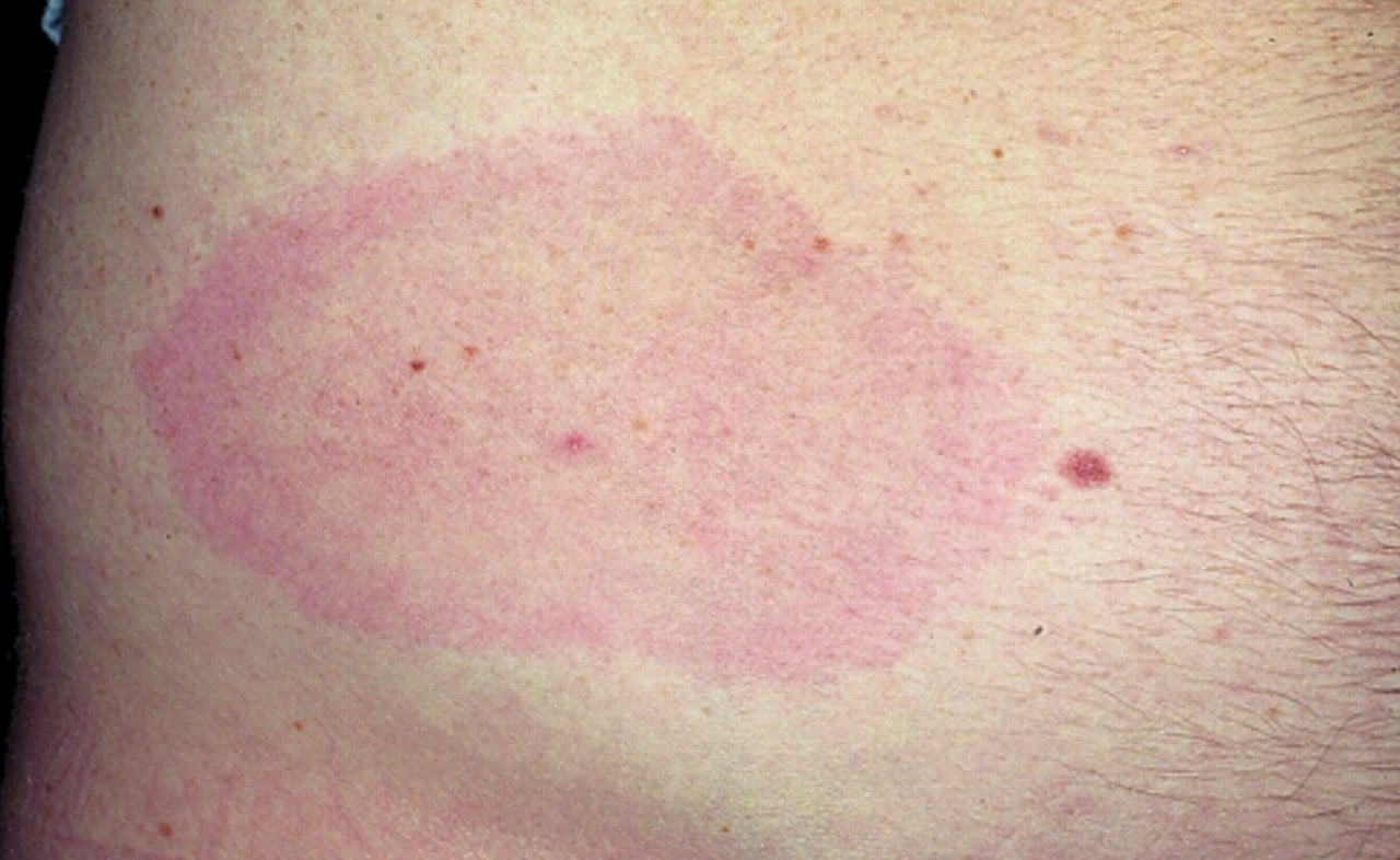 The characteristic bullseye rash for Lyme disease | Innatoss